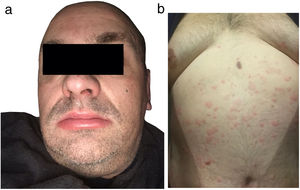 Se observan el edema labial y la urticaria en la frente y el tronco.