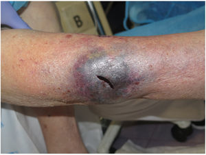 Tras el drenaje de un hematoma profundo disecante se aplicará terapia compresiva adaptada a la persona.