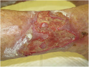 Úlcera por arterioloesclerosis secundaria a edema agudo por insuficiencia cardíaca descompensada.