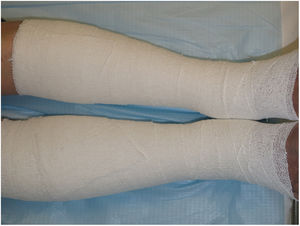 Bota de Unna.
