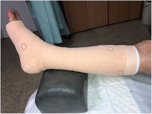 Vendaje multicomponente con marcadores de presión circulares.