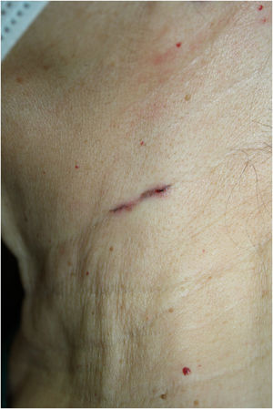 Presentación clínica del caso: zona cervical izquierda.