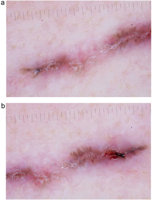 Imágenes dermatoscópicas con luz polarizada (a y b). No se objetiva retículo pigmentado. Se observan estructuras en hoja de arce, puntos y glóbulos azul-gris, así como ulceración y varias erosiones.