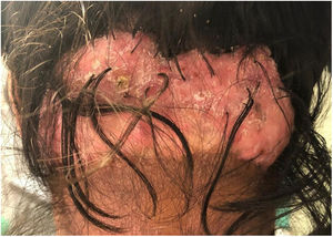 Placa de aspecto cicatricial de 15 ×10cm en la que se observan varios folículos en penacho.