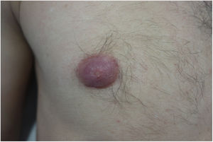 Erythematous-violaceous, thickened, and infiltrated right mammary areola.