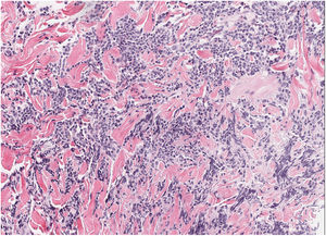 Skin biopsy of the right areola. Hematoxylin and eosin, ×100. Dense dermal lymphoid infiltrate composed of intermediate-sized cells with occasional large cells. Presence of germinal centers and non-confluent in deep dermis.
