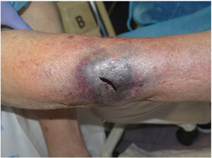 After drainage of a deep dissecting hematoma, compression therapy adapted to the individual will be applied.