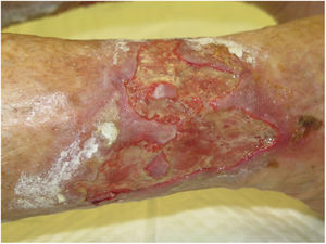 Atherosclerotic ulcer following acute edema due to decompensated heart failure.