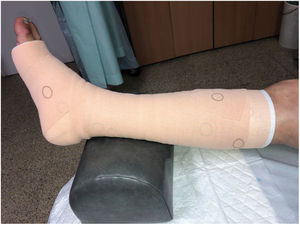 Multicomponent bandage with circular pressure markers.
