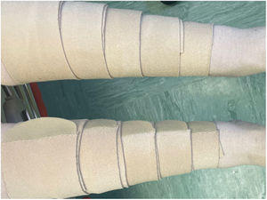 Self-adjusting compression system with Velcro closure.