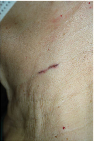 Clinical case presentation: left cervical area.