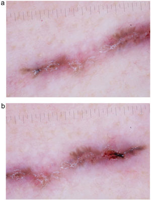 Dermoscopic images with polarized light (a and b). Absence of pigmented network. Presence of maple leaf-like structures, dots, blue-gray globules, ulceration, and several erosions.