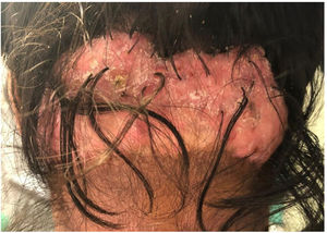 15cm × 10cm scarred plaque with several hair follicles in tuft.