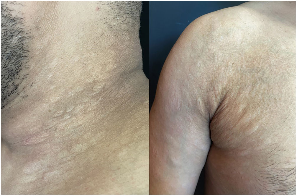 Aetoderma Secondary Syphilis-Induced Anetoderma | Actas Dermo-Sifiliográficas