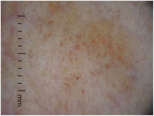 Imagen dermatoscópica.
