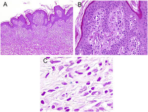 Estudio histopatológico. (A) Hematoxilina-eosina, ×10. (B) Hematoxilina-eosina, ×63. (C) Tinción de Perls.