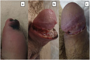 a) Placa necrótica en el prepucio y cuerpo de pene edematoso. b) Cuerpo del pene con dehiscencia de la herida quirúrgica y aumento de la necrosis. c) Cuerpo del pene con disminución del edema, resolución de la dehiscencia y de la necrosis.
