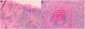 a) Hematoxilina-eosina x10. Necrosis epidérmica y densa inflamación crónica. b) Hematoxilina-eosina x20. Vasculitis con trombosis.