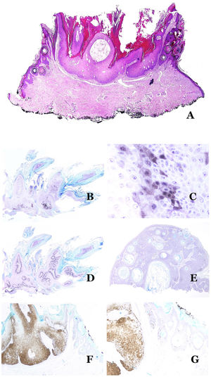 A) Cambios de verruga vulgar en colisión con áreas periféricas de QS (H&E x20). B, C y D) Características típicas de una seborruca en el estudio inmunohistoquímico. La seborruca muestra parches de tinción positiva con p16 (B: p16, x20). Los parches son de más de 10 células juntas positivas para p16, con una tinción tanto citoplásmica como nuclear (C: p16, x400). El Ki-67 muestra positividad exclusivamente en la capa basal de la lesión (D: Ki67, x20). Por el contrario, la QS es p16 negativa (E: p16, x20). Cuando se observan lesiones de colisión entre verruga y QS, las áreas de verruga son p16-positivo mientras que las áreas de QS son p16-negativo (F: p16, x20; G: p16x40).