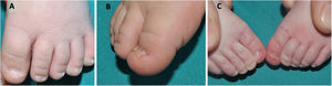 A) Uñas de un recién nacido con morfología triangular, líneas de Beau y coiloniquia. B) Coiloniquia con los bordes de la uña evertidos y una concavidad central. C) Hipertrofia del pliegue lateral de los primeros dedos del pie de un neonato que cubre parte de la lámina ungueal.