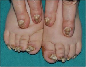 Paquioniquia congénita en una madre y su hijo. En las uñas de los pies se observa un gran aumento en el grosor de la lámina ungueal y el lecho ungueal que adquiere forma de gancho, junto con una coloración blanco-amarillenta. Se observa además una queratodermia plantar en el borde interno del primer dedo del pie izquierdo. En las uñas de las manos observamos también una paquioniquia, junto con una coloración amarillenta-marronácea.