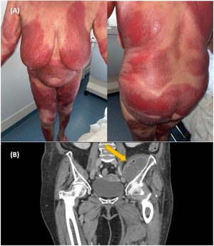 Caso 1. (A) Eritrodermia psoriásica. (B) La TC muestra un absceso en el músculo iliaco.