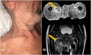 Caso 2. (A) Linfoma de células T cutáneo eritrodérmico exfoliativo. (B) La IRM muestra un absceso iliaco.