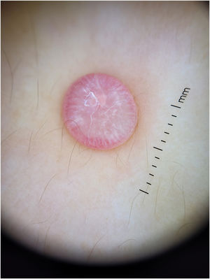 Imagen de dermatoscopia con contacto polarizada de la lesión.