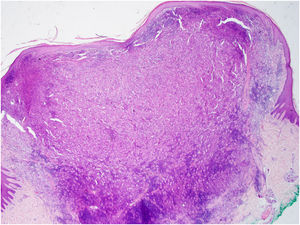Gran nódulo dérmico (hematoxilina–eosina, ampliación de 20×).