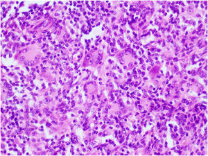 El nódulo se compone principalmente de células gigantes multinucleadas de tipo Touton (hematoxilina–eosina, ampliación de 400×).