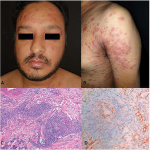 Numerosas pápulas, placas y nódulos eritematosos-violáceos infiltrados, con distribución simétrica en cara, cuello, tronco y brazos (A, B). La tinción de hematoxilina y eosina (100×) muestra un infiltrado denso granulomatoso perivascular y perianexial con células plasmáticas e histiocitos en dermis superficial y profunda (C); la inmunotinción para T. Pallidum (100×) resalta de forma robusta la presencia de espiroquetas perivasculares e intraepidérmicas (D).