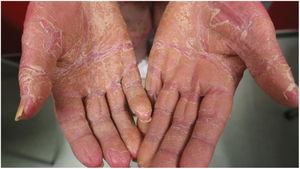 Queratodermia palmoplantar en un paciente con PRP.