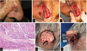 A) Patient #2, squamous tumor on the nasal wall. B and C) Intraoperative appearance suggesting deep infiltration of nasal cartilages. D) Hematoxylin and eosin stain, 200x, showing tumor with perineural infiltration. E and F) Patient #3, large fleshy tumor with spontaneous bleeding affecting almost the entire pinna.