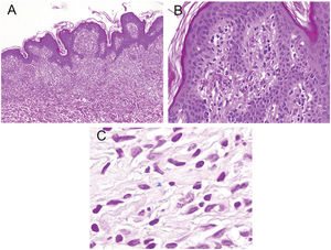Histopathological study. (A) Hematoxylin-eosin, ×10. (B) Hematoxylin-eosin, ×63. (C) Perls’ staining.
