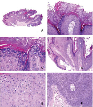 Histopathological features observed in seborrhuca: A) papillomatous silhouette (H&E x20). B) parakeratotic columns at the tips of the papillae with agranulosis (H&E x100). C) thick keratohyalin granules (H&E x200). D) tortuous capillary vessels in the papillae (H&E x100). E) koilocytes (H&E x400). F) overgrowth of monomorphic basaloid cells (H&E x100).