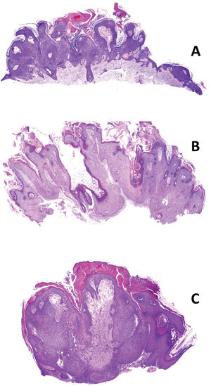 Three examples of seborrhucas showing typical features commonly shared by warts and SK (H&E x20). Many whorls can be seen in B.