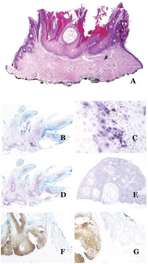 A) Changes of common wart in collision with peripheral areas of SK (H&E x20). B, C, and D) Typical features of seborrhuca in the immunohistochemical study. Seborrhuca shows patches of positive staining with p16 (B: p16, x20). The patches consist of more than 10 cells positive for p16, with both cytoplasmic and nuclear staining (C: p16, x400). Ki-67 shows positivity in the basal layer of the lesion only (D: Ki67, x20). In contrast, SK is p16 negative (E: p16, x20). When collision lesions between wart and SK are seen, the wart areas are p16-positive while the SK ones are p16-negative (F: p16, x20; G: p16 x40).