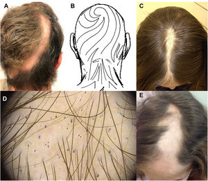 Linear alopecia areata. (A) Linear alopecic patch extending from the vertex to the left occipital area, following Blashko