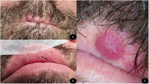 Nódulo eritematoso de superficie lisa localizado en labio superior de aspecto angioide (A), pápula eritematosa en mucosa interna de labio superior (flecha negra) (B). Patrón homogéneo eritematoso con áreas blanquecinas y vasos tortuosos dilatados (Dermlite® DL4, Dermlite LLC, EE. UU.) (C).