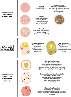 Representación esquemática de la dermatoscopia de las queratosis actínicas, enfermedad de Bowen y queratoacantoma/carcinoma epidermoide invasor.