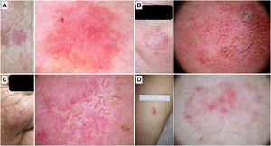 Queratosis actínicas no pigmentadas. A) Queratosis actínica grado 1 en la cara de una mujer de 81 años. En la dermatoscopia se aprecian un seudorretículo rojizo y una descamación discreta. B) Queratosis actínica grado 2 facial en un varón de 72 años. Patrón dermatoscópico «en fresa», con folículos prominentes/«rosetas», vasos ondulados perifoliculares y queratina. C) Queratosis actínica grado 3 en la cara de una mujer de 80 años. Con dermatoscopia se aprecian masas de queratina en forma de áreas blanco-amarillentas sin estructura. D) Queratosis actínica bowenoide en la pierna de una mujer de 80 años. En la dermatoscopia se observan múltiples vasos puntiformes/glomerulares.