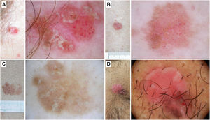 Enfermedad de Bowen. A) Enfermedad de Bowen no pigmentada en la sien de una mujer de 79 años. Patrón dermatoscópico compuesto por escamas blanco-amarillentas y agregados de vasos glomerulares. B) Enfermedad de Bowen no pigmentada en la espalda de un varón de 55 años. En la dermatoscopia se observa una descamación discreta y vasos glomerulares y puntiformes. C) Enfermedad de Bowen pigmentada en la espalda de un varón de 31 años. Con dermatoscopia puede apreciarse una pigmentación marrón sin estructura, agregados de vasos glomerulares y puntos marrones y grises dispuestos en líneas. D) Enfermedad de Bowen genital en el pubis de un varón de 59 años. En la dermatoscopia se puede observar un área de pigmentación marrón sin estructura, puntos marrones dispuestos en líneas, vasos puntiformes y líneas blancas brillantes.