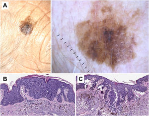 Correlación histopatológica en queratosis actínica pigmentada con áreas de carcinoma epidermoide in situ. A) Lesión pigmentada atípica en la sien de una mujer de 75 años. Imagen dermatoscópica, en la que se observan áreas de pigmentación marrón homogénea, círculos marrones, gránulos azul-gris y puntos grises dispuestos en líneas en el polo inferior de la misma. En este caso los hallazgos dermatoscópicos no permiten un diagnóstico fiable y el estudio histológico resulta imprescindible. B) Imagen histopatológica de un área de carcinoma epidermoide in situ (enfermedad de Bowen) con melanófagos en dermis superficial (hematoxilina eosina, ×10). C) Área de queratosis actínica proliferativa con queratinocitos pigmentados y melanófagos en la dermis superficial (hematoxilina eosina, ×10).