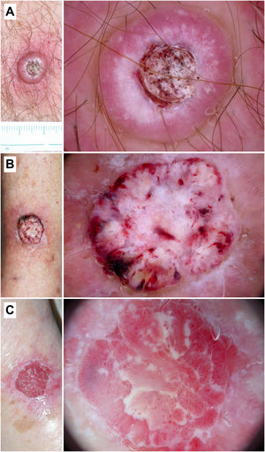 Queratoacantoma y carcinoma epidermoide invasivo. A) Queratoacantoma en el tórax de un varón de 54 años. En la dermatoscopia se observa una masa de queratina central, terrones y círculos blancos, áreas blancas sin estructura y vasos «en horquilla» con una distribución radial. B) Carcinoma epidermoide bien diferenciado en la pierna de una mujer de 88 años. Con dermatoscopia se aprecian áreas blanco-amarillentas sin estructura, terrones y círculos blancos, un patrón vascular polimorfo y hemorragias. C) Carcinoma epidermoide pobremente diferenciado en el brazo de una mujer de 89 años. En la dermatoscopia puede verse un predominio del color rojo y de un patrón vascular francamente atípico, con apenas criterios asociados a queratinización.