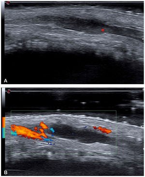 a: B-mode ultrasound image (18 MHz) showing a hypoechoic and dilated tubular structure, which is consistent with a superficial vein. This structure was not compressible under pressure. The hyperechoic content indicated by the asterisk corresponds to the intraluminal thrombus. b: Power Doppler ultrasound image showing absence of flow inside the thrombosed vein. The image Doppler flow comes from one of the dorsal arteries of the penis.