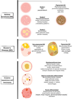 Schematic representation of dermoscopy of actinic keratoses, Bowen