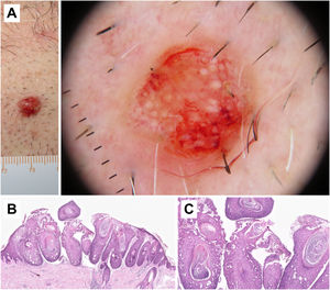 Histopathological correlation in microinvasive squamous cell carcinoma. A) Erythematous papule on the chest of a 46-year-old man. B) Dermoscopic image shows white clods and a polymorphous vascular pattern with linear irregular, “hairpin,” and glomerular vessels. C) Histopathological image shows epithelial proliferation with acanthosis and bulbous nests, revealing acantholysis and central keratinization phenomena (hematoxylin and eosin, ×2). D) Higher magnification image showing tumor cells and keratinization areas (“horn pearls”), corresponding to the white clods seen in dermoscopy (hematoxylin and eosin, ×5).