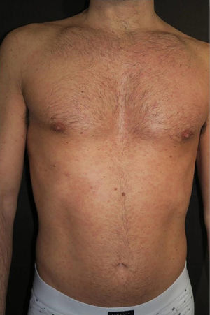 Maculopapular rash on trunk with fine scaling called syphilitic roseola.