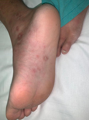 Plantar papules with scaling collar known as «clavos».