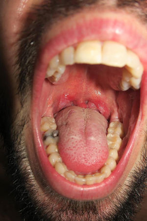 Whitish plaques on the uvula and tonsils that are sometimes a presentation of secondary syphilis.